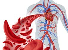 Stock Photo illustration of Sickle Cell Heart Circulation