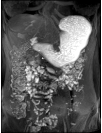 Image related to Gastroparesis - showing internal organs