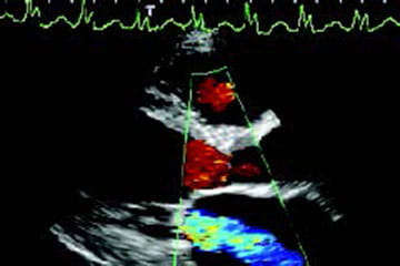 Echocardiography Sonography Image