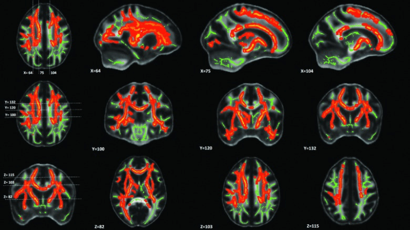 Imaginges of brains scans for concussion.