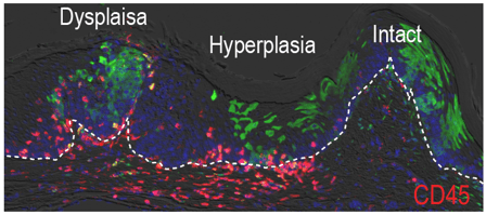 imaging of cells shows areas marked as dysplasia, hyperplasia and intact