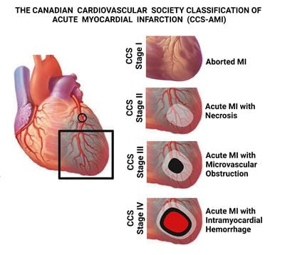 This illustration outlines four stages the Canadian Cardiovascular Society has endorsed for its new CCS Classification of Acute Myocardial Infarction (CCS-AMI), which is the world’s first clinical classification for a heart attack based on heart tissue damage.
