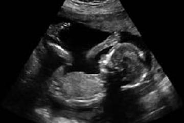 Sonogram of fetus